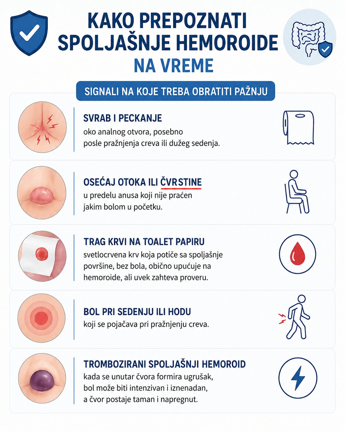 infografik spoljašnjih hemoroida